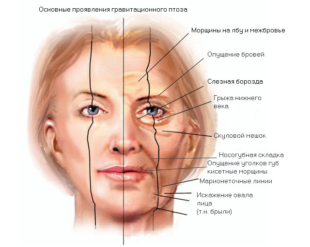 Птоз кожи и методы борьбы с ним | Мезотерапия и косметология в клинике  Vitaura