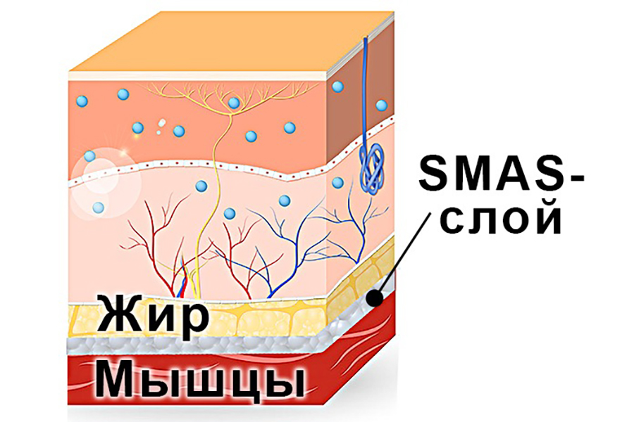 SMAS-лифтинг