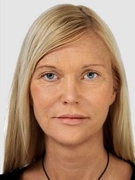 мезотерапия лица фото